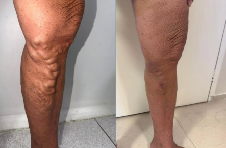 Antes e depois de tratamento cirúrgico de varizes, pelo Dr. Pedro Neto no CDVASC