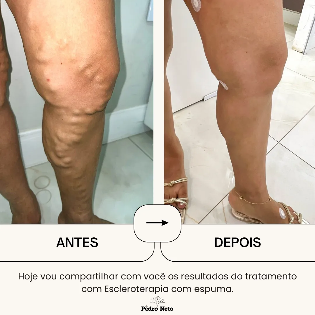 Antes e depois do tratamento de escleroterapia com espuma para varizes, pelo Dr. Pedro Neto