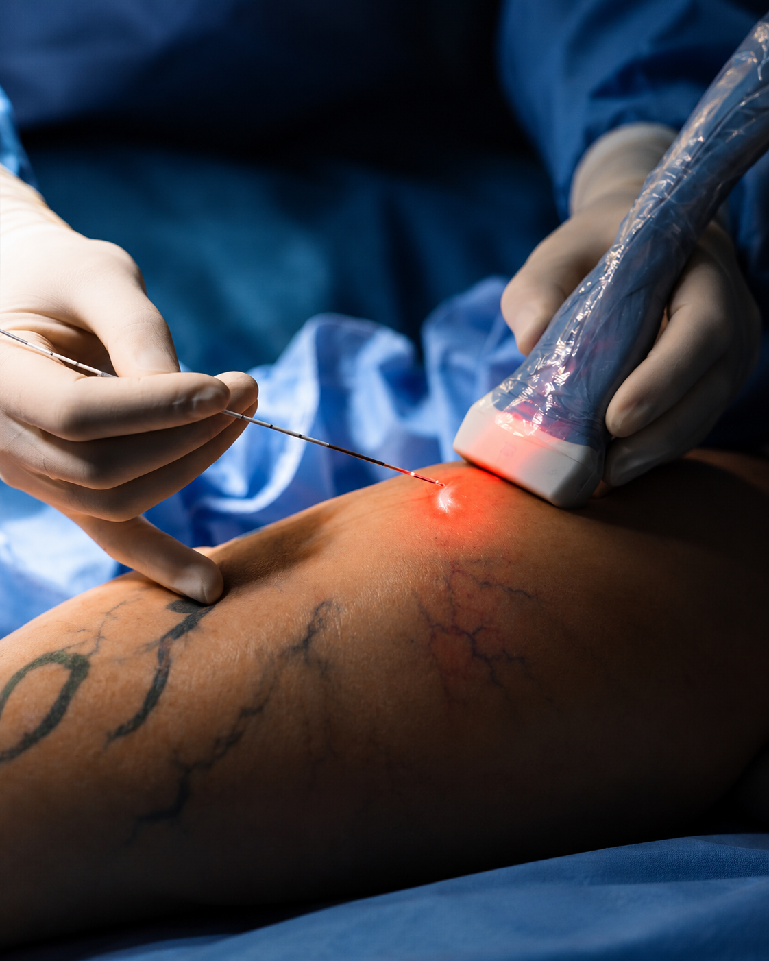 Procedimento de Endolaser para tratamento de varizes